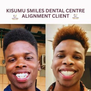 braces befor and after