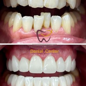 braces before and after 11
