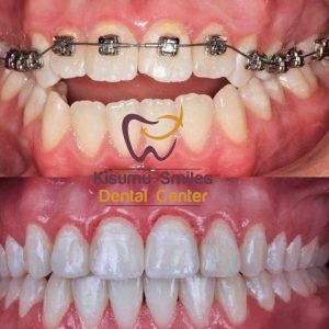 braces before and after