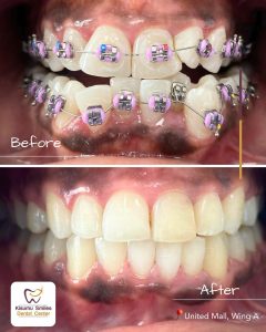 braces before and after 33