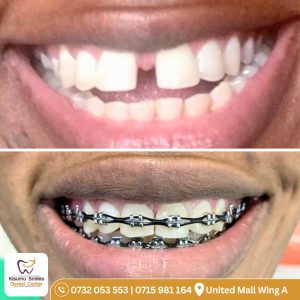 braces before and after 555