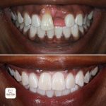 dental implants before and after 22