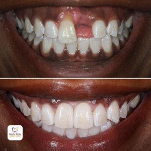 dental implants before and after 22