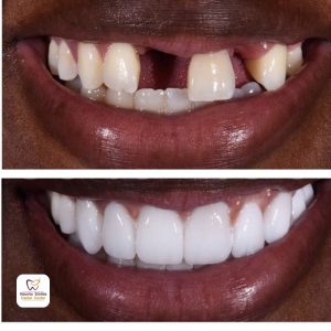 dental implants before and after