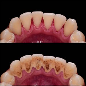 teeth calculus and tartar cleaning