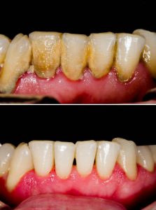 Before and after dental tartar removal - professional oral hygiene.