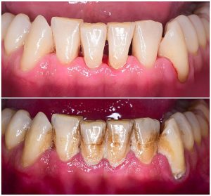 teet tartar and calculus cleaning