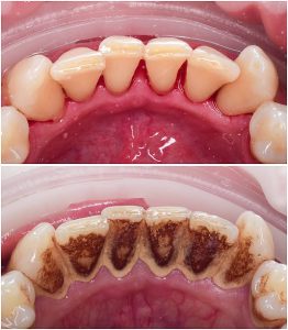 teet tartar and calculus cleaning