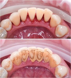 teeth calculus and tartar cleaning