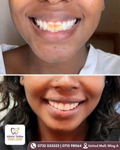 teeth whitening before and after 22