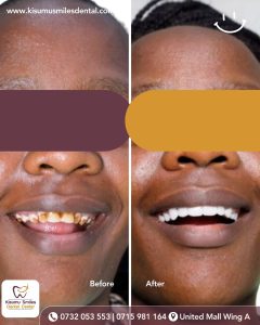 teeth whitening before and after 222