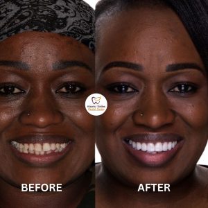 teeth whitening before and after