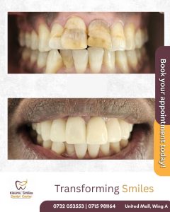 teeth whitening before and after 33