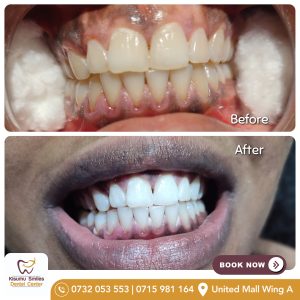 teeth whitening before and after 44