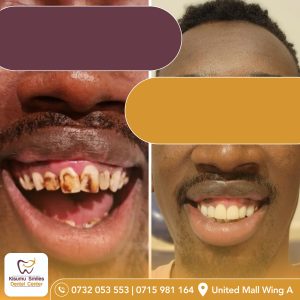 teeth whitening before and after 55